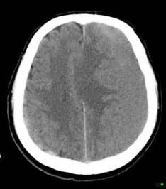 Subdural Hemorrhage Summary Radiology Reference Article The Best Porn