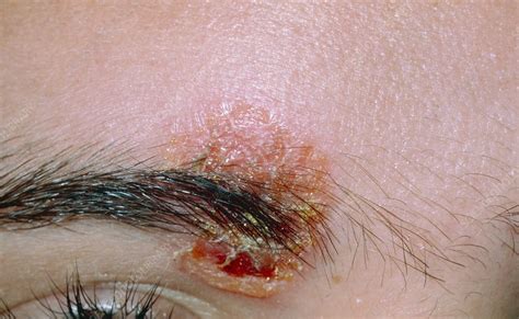 Impetigo On Skin Around Eyebrow Stock Image M1800074 Science Photo