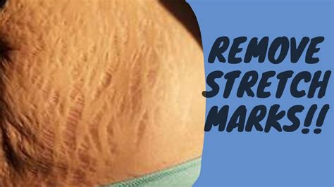 How To Remove Stretch Marks Get Rid Of Stretch Marks And Scars Fast