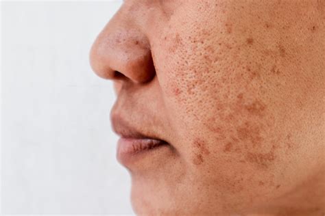 Dark Spots On Face Causes 07 Natural Skin Lighters Diyvines