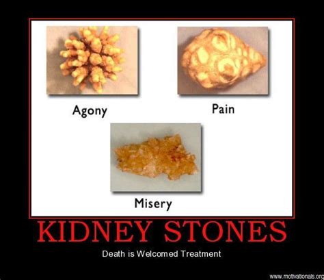 The most common kidney stone humor material is metal. 119 best Stupid body pains images on Pinterest