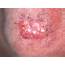 HEALTH FROM TRUSTED SOURCES Basal Cell Carcinoma