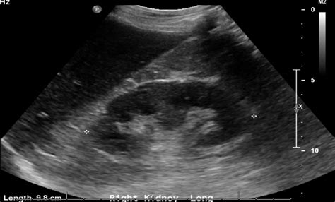 Hiding In Plain Sight A Case Of Perinephric Abscess Diagnosed By Pocus
