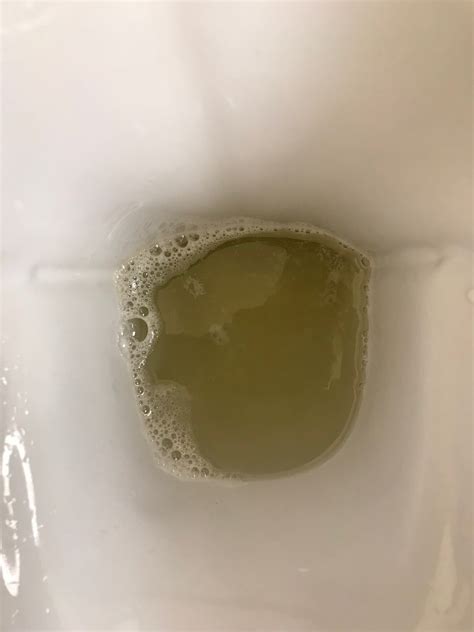 UKidney - Foam in urine but no protein found.