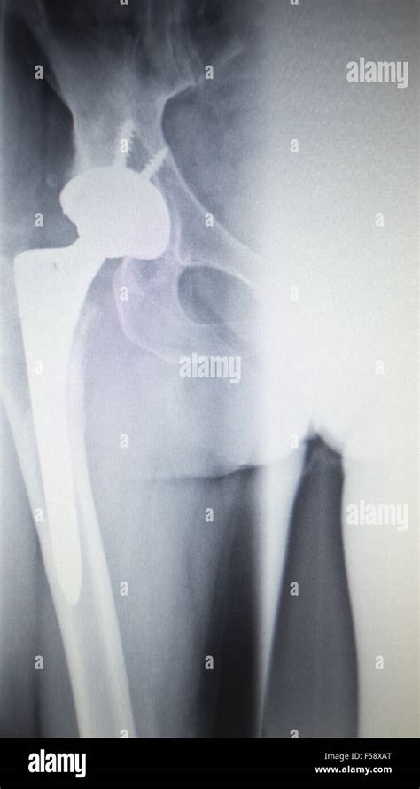 X Ray Scan Image Of Hip Joints With Orthopedic Hip Joint Replacement