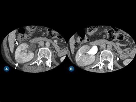 Acute Pyelonephritis Contrast Enhanced Ct Images On A Nephrographic