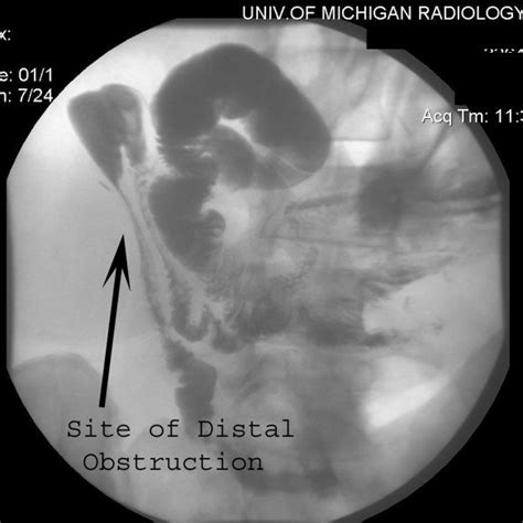 Fistula Injection With Small Bowel Follow Through Demonstrating Distal