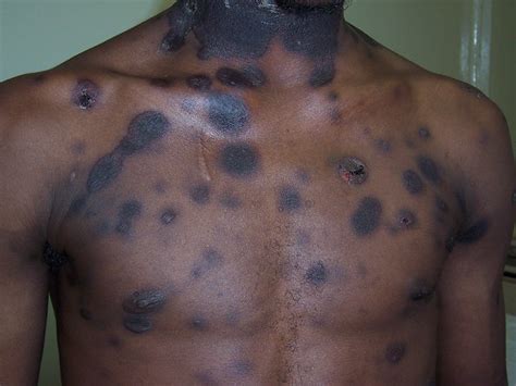 Steven's Johnson Syndrome | Flickr - Photo Sharing!