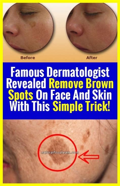 The Famous Dermatologist Revealed Remove Brown Spots On Face And Skin