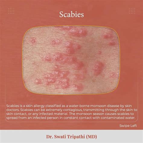 Scabies Is An Itchy Highly Contagious Drswati Tripathi