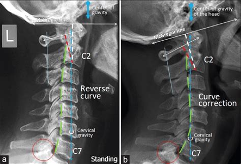 Reversal Of Cervical Lordosis Treatment Quotes Update Viral
