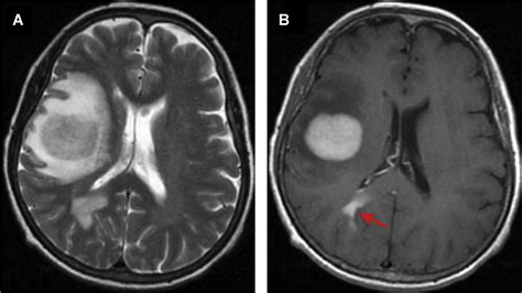 Adult Primary Brain Neoplasm Including World Health Organization