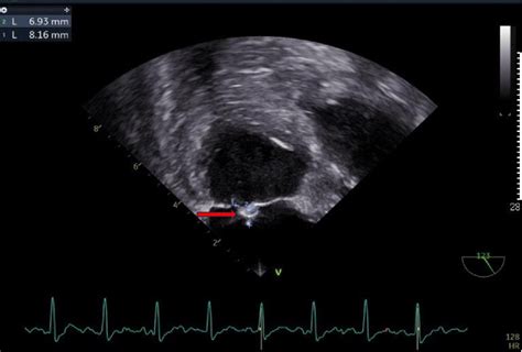Figure 1 From Successful Surgical Treatment Of Mitral Valve