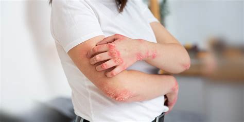 Fungal Infections Types Symptoms And Natural Treatments