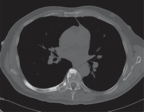 Chest Wall The Ribs Radiology Key