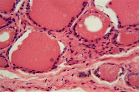 Cells Of A Human Thyroid Gland With Swelling Under A Microscope Stock