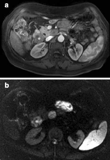 Mri Shows Enlarged Lymph Node Near The Pancreatic Head A T1 Weighted