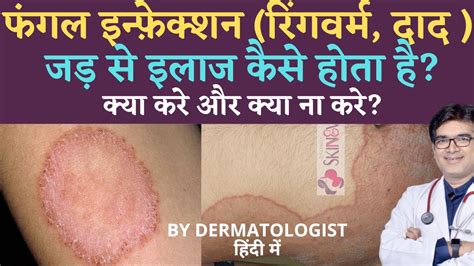 Fungal Infection In Private Parts Skin Treatment Daad Ka Ilaj Cream
