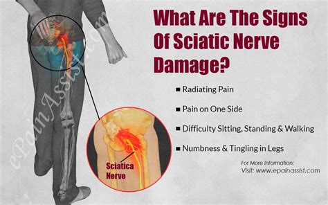 The Sciatic Nerve Causes Of Sharp Shooting Pain Down The Leg Brandon
