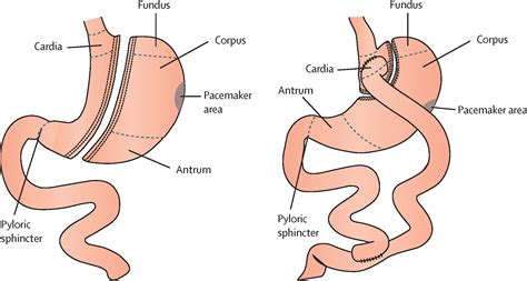 Adaptations In Gastrointestinal Physiology After Sleeve Gastrectomy And Roux En Y Gastric Bypass