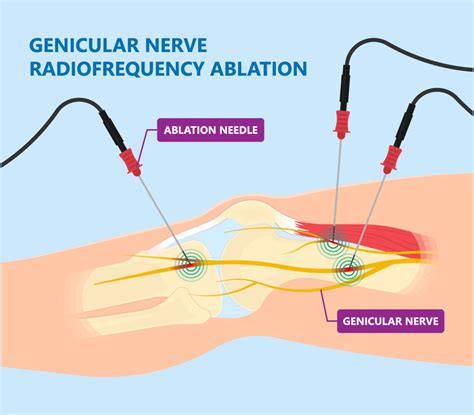 Genicular Nerve Block And Radiofrequency Ablation Rfa Excel Pain