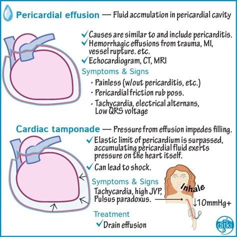 Preview Of Our Upcoming Tutorial On Pericardial Diseases Click The