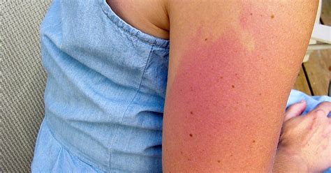 Tanning Bed Rash White Spots Heat Rash And Itchiness After Tanning