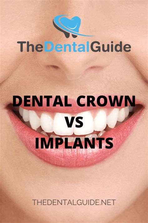 Dental Crown Vs Implants The Dental Guide