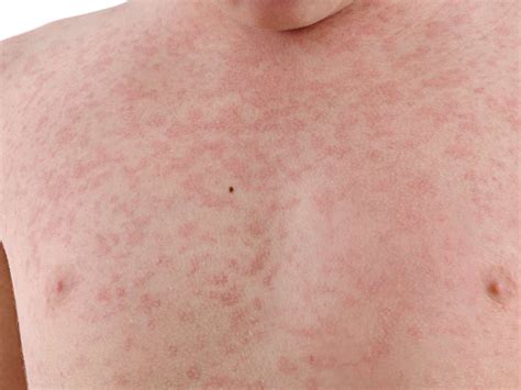 German Measles Rubella Causes Symptoms And Treatments