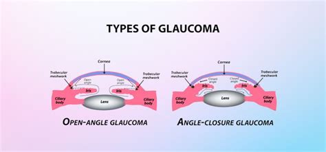 Is Glaucoma Hereditary Decoding Glaucoma Inheritance Medical Elevate