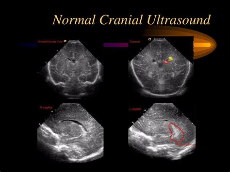Normal Neonatal Cranial Ultrasound