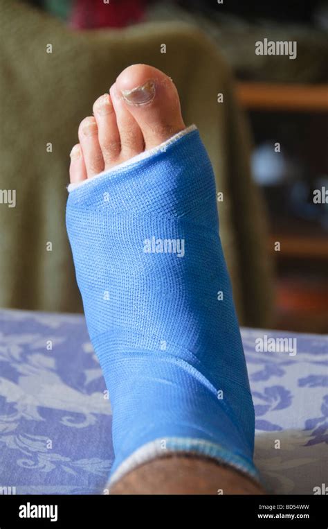 Fiberglass Cast On A Broken Ankle Stock Photo Alamy