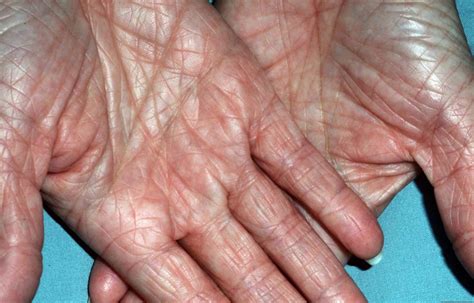 Ichthyosis Vulgaris Causes Symptoms Complications And Treatment
