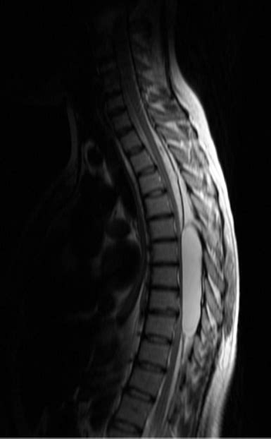 Spinal Epidural Arachnoid Cyst Mri Sumers Radiology Blog