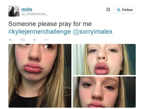 Kylie Jenner Lip Challenge Consequences Famous Person