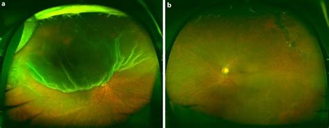 A Wide Field Fundus Photography Of The Right Eye Before Surgery