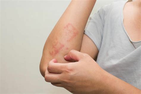 Heres All That You Need To Know About Scabies Skin Rash Insightmania