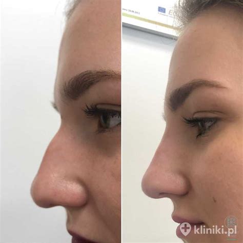 Korekta kształtu nosa kwasem hialuronowym zdjęcia przed i po Kliniki pl