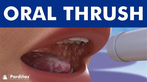 Oral Infection Telegraph