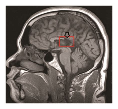 MRI Demonstrating Partial Agenesis Of The Corpus Callosum With The