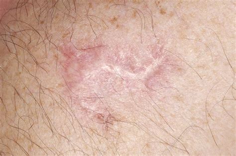 Skin Cancer Scar Stock Image C Science Photo Library