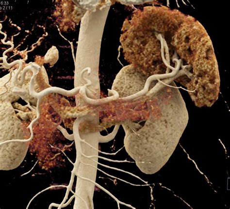 Normal Pancreas And Spleen With Cinematic Rendering Spleen Case