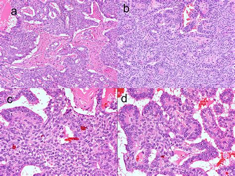 Cureus Spindle Epithelial Tumor With Thymus Like Differentiation