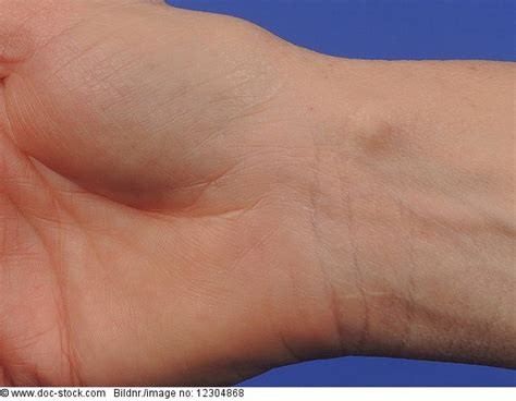 Synovial Cyst Of The Wrist Rights Managed Image Doc Stock