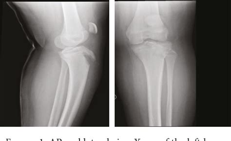 Figure From Avulsion Fracture Of The Tibial Tuberosity Combined With
