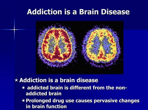 Ppt Addiction Is A Brain Disease Powerpoint Presentation Free Download Id5913442