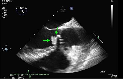 Cureus Embolic St Elevation Myocardial Infarction From Candida