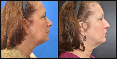 Coolsculpting Of Neck Dr Dean Kane Center For Cosmetic Surgery And Medispa