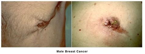 The literature suggests that for every male who are diagnosed with breast cancer, there will be approximately 100 females diagnosed with breast cancer. Male Breast Cancer: Know the Facts