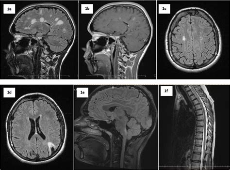 Differential Diagnosis Of Multiple Sclerosis And Other Inflammatory Cns